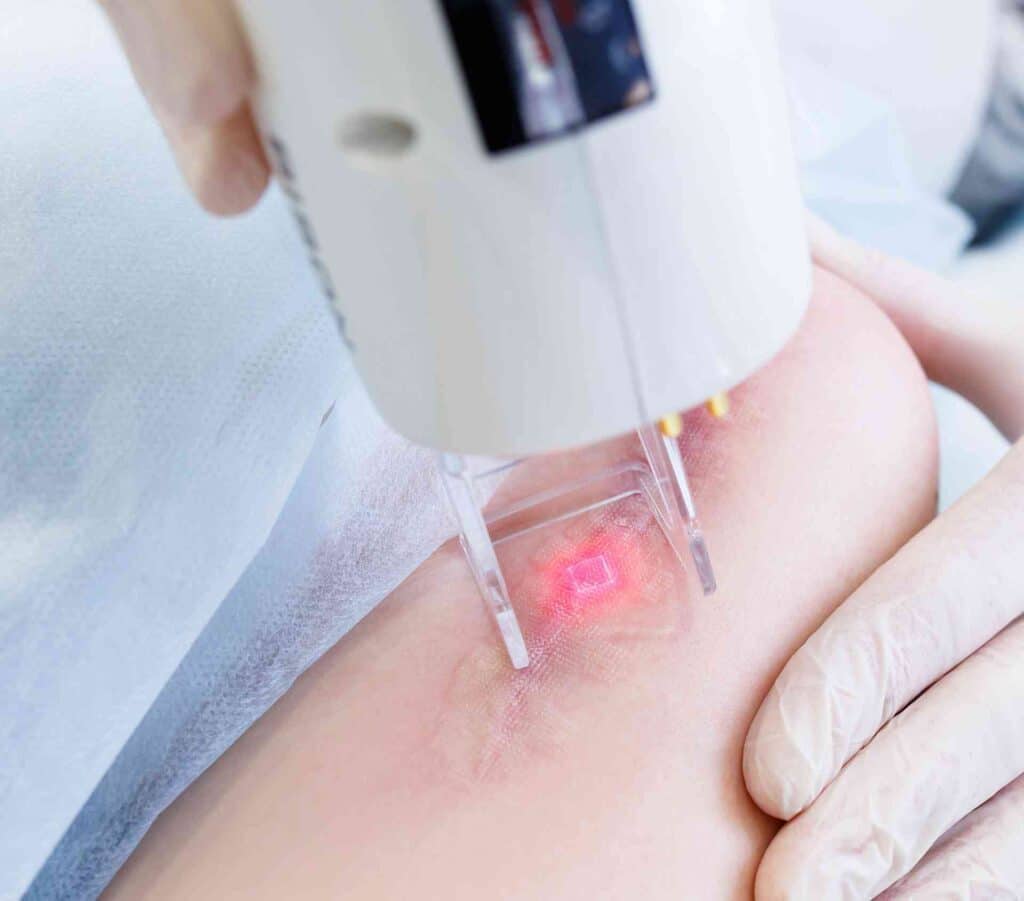 fractional laser scar removal